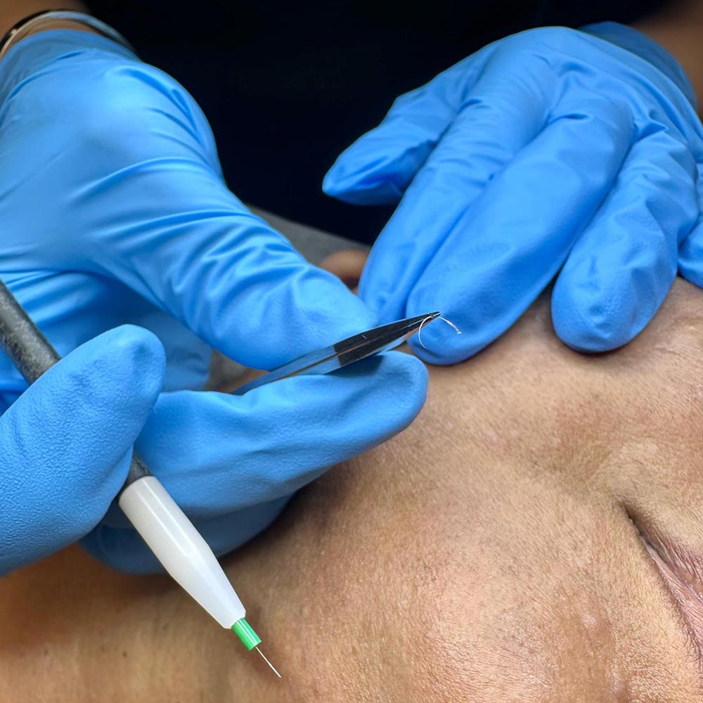 Electrolysis Permanent Hair Removal in Toronto