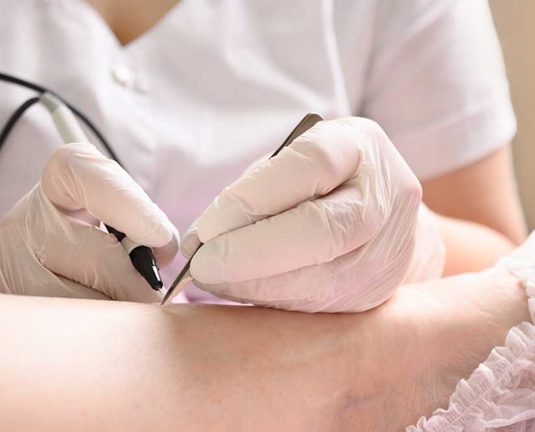 Electrolysis Permanent Hair Removal Toronto